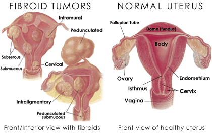 education-fibroid-tumors